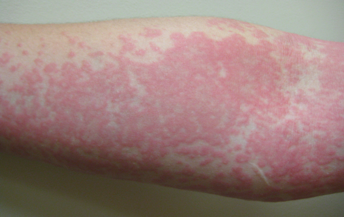 Forearm with red, speckled, angry rash representing urticaria