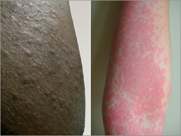 Image of a person’s arm with urticaria, or hives